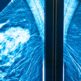 Mastectomie prophylactique : pour qui et pourquoi ?