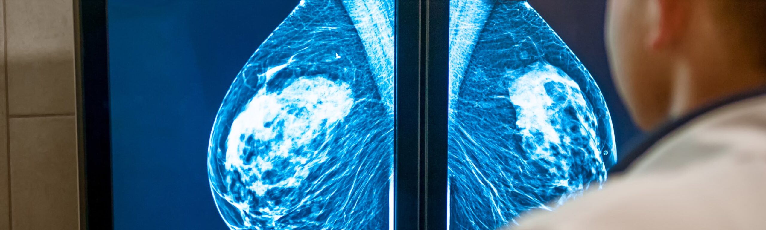 Mastectomie prophylactique