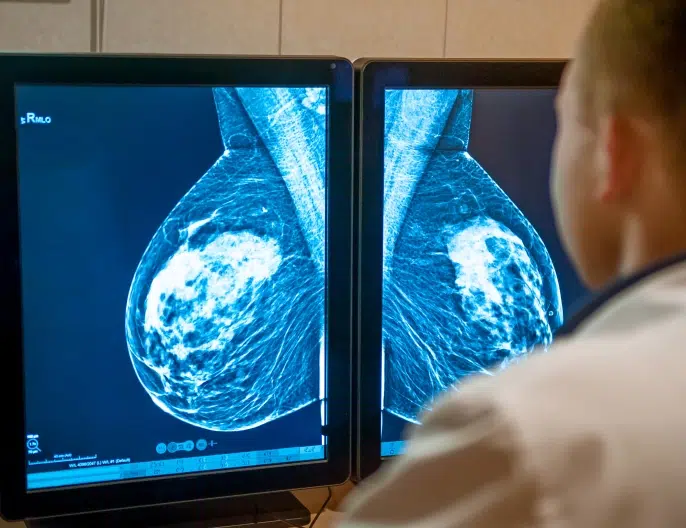 Mastectomie prophylactique