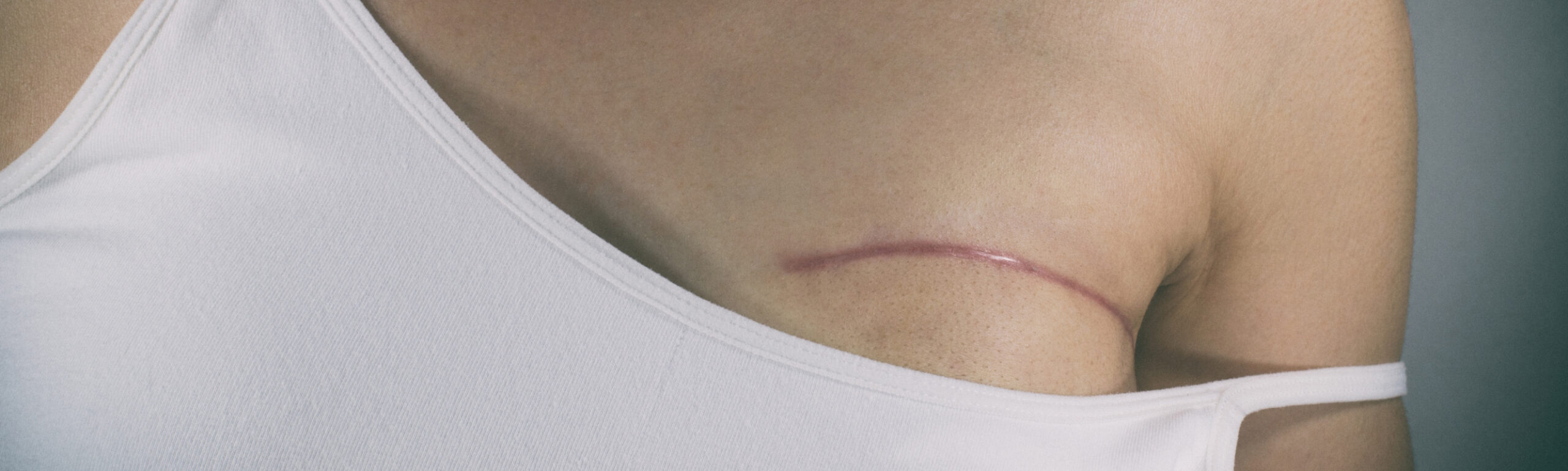 Mastectomie préventive