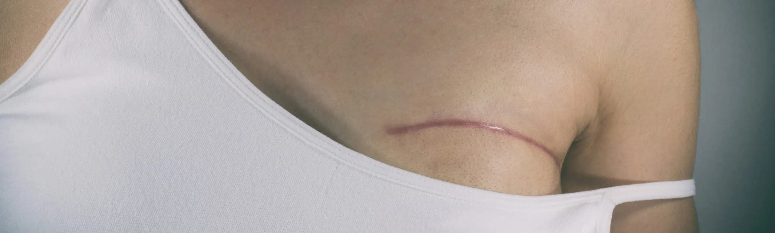 Mastectomie préventive