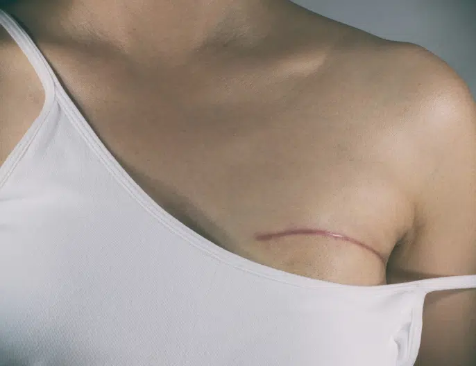 Mastectomie préventive