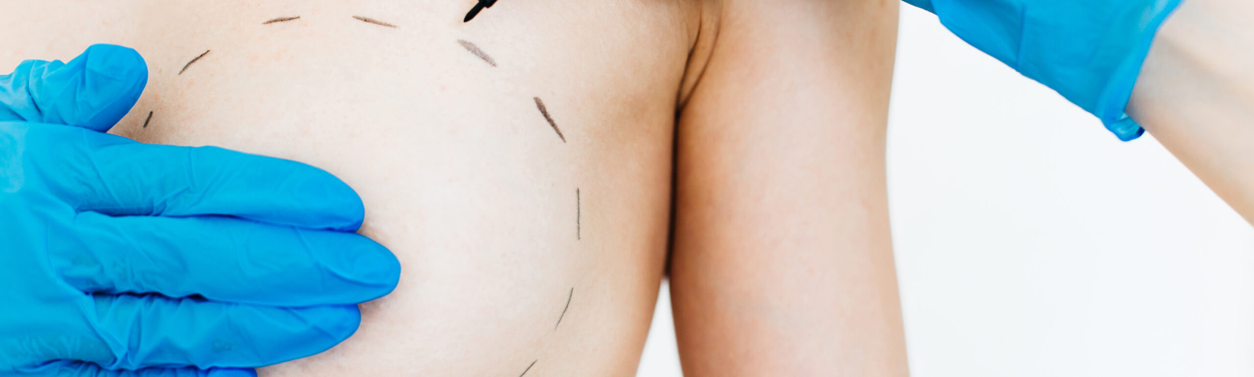 Augmentation mammaire Préservé | MIB Center Paris