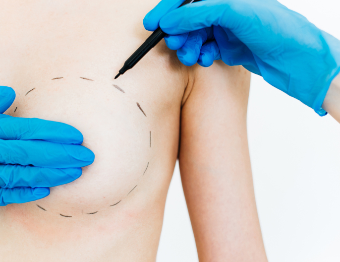 Augmentation mammaire Préservé | MIB Center Paris